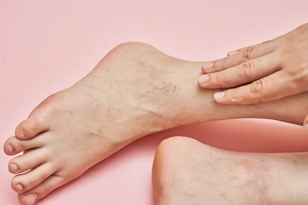 How To Sleep Better With Varicose Veins